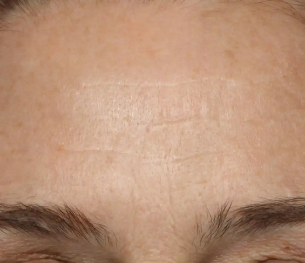 forehead skin after using Nuface product